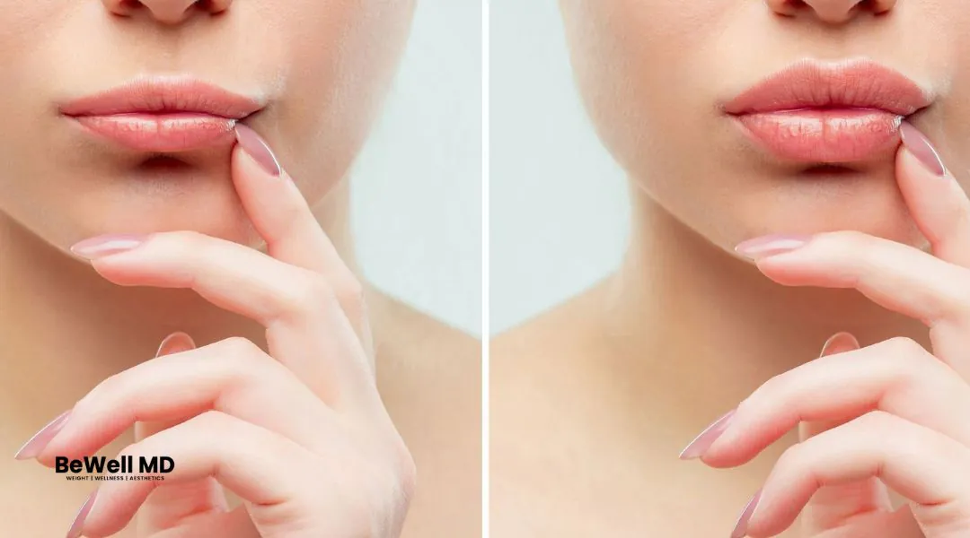 before and after lip flip